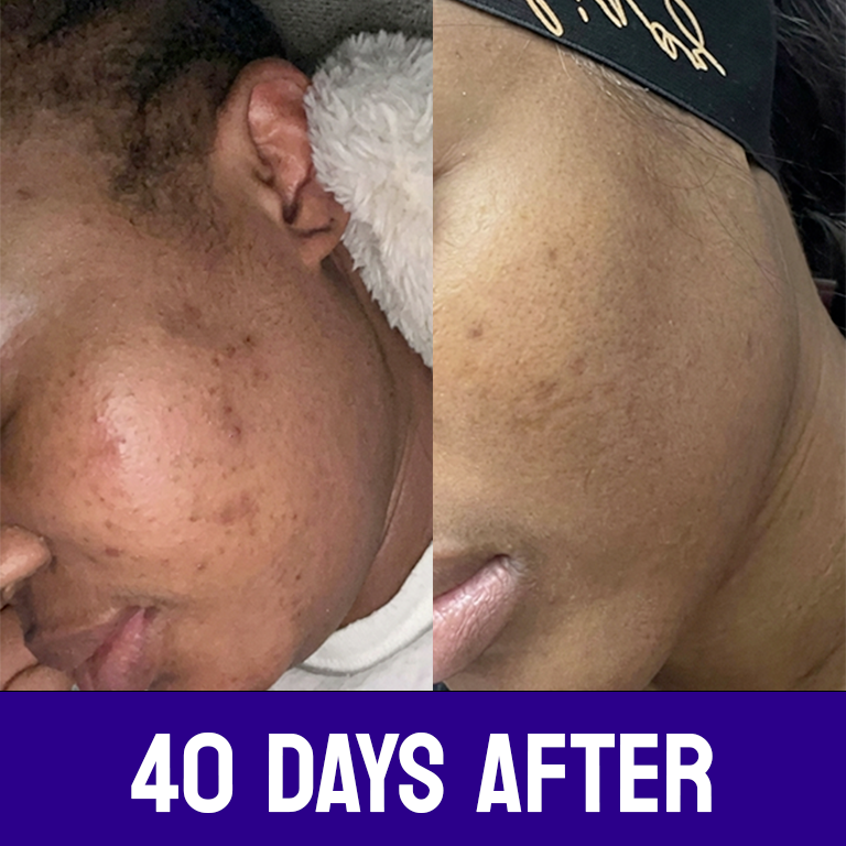 Intense Discoloration Treatment
