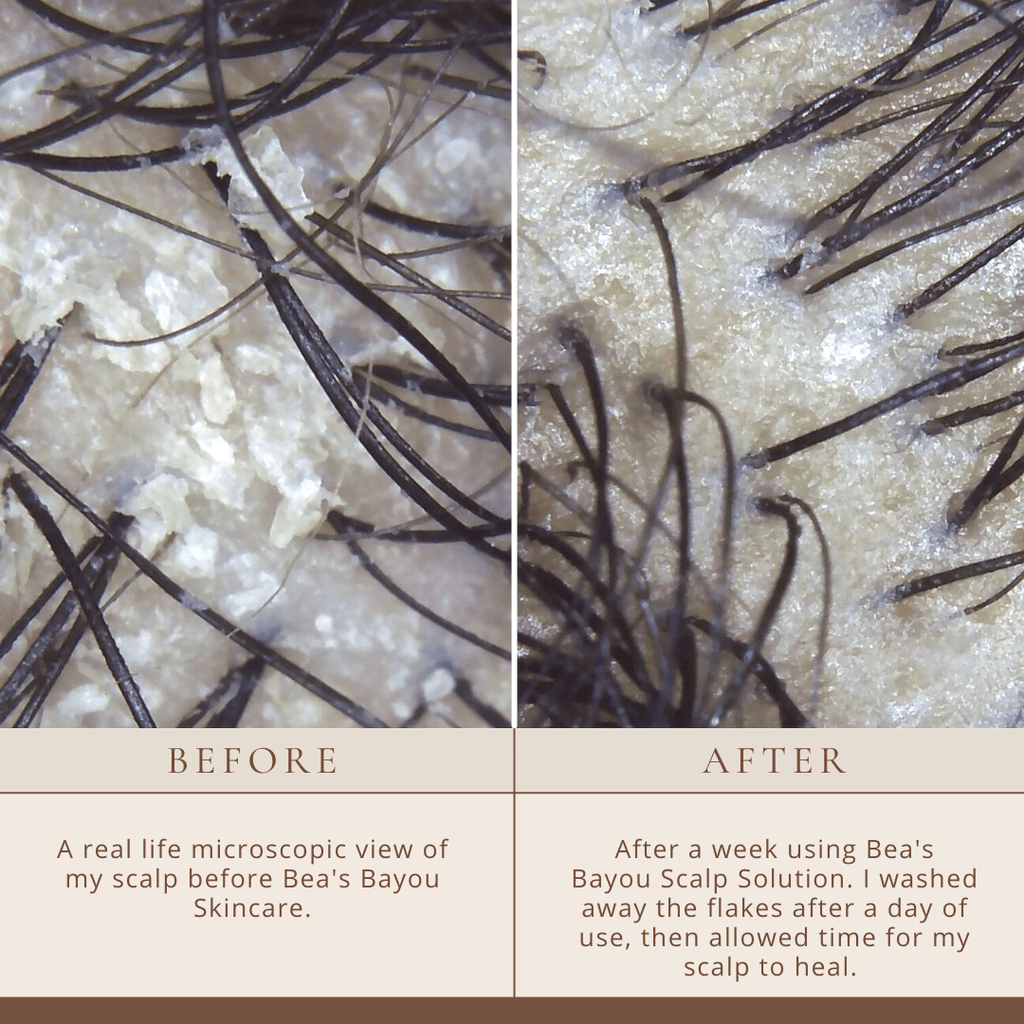 Seborrheic Scalp Solution Double Bundle | YeastDefense™️